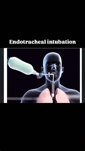 How Doctors Secure the Airway in Emergencies | Life-Saving Airway Endotracheal Intubation | ICU & ER