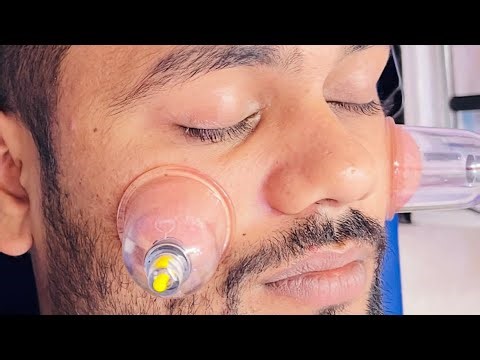 Hijama for Acne Scars // Therapy Treatment and Benefits