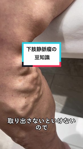 下肢静脈瘤の豆知識👨🏻‍⚕️