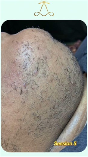 🤯 🤩 From sugar wax to 1st session of permanent hair removal to 5th session on the chin #dallaswax