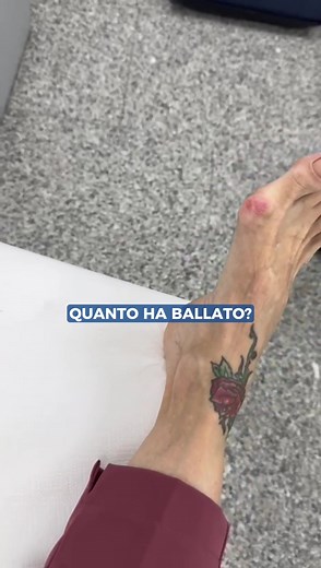 Metodo Avi per alluce valgo: Chirurgia mini invasiva