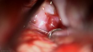 #63: Pterional Craniotomy, Extradural Anterior Clinoidectomy, and Clipping of Ophthalmic Artery and Superior Cerebellar Artery Aneurysms - All Videos - Seven Series Collection