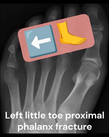 Little toe proximal phalanx fracture