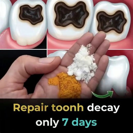 100% Natural Home Remedy for Tooth Decay, Yellow Teeth, and Tooth Pain 👇 | K Line Global