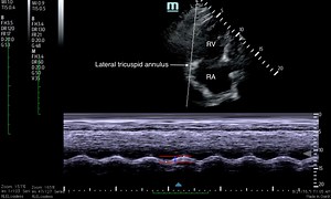 Tricuspid Annular Plane Systolic Excursion (TAPSE) in a Patient with Pulmonary Emboli - JETem