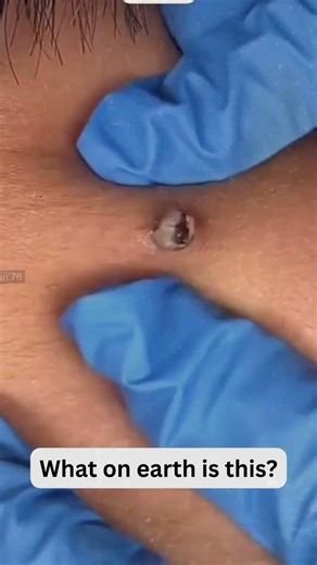 Deep Blackheads, Milia & Whitehead Removal pimple popping New| Big Cystic Acne Extraction #1194 2026