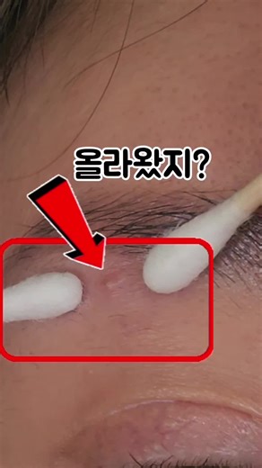 올라왔지? 짰지? 발라찌? 없어졌지! 여드름 짜고 나면 항상 걱정됐던 자국… 근데 요즘은 걱정 안 해요. 딱 하나, 이것만 바꿨어요. 바르기만 했는데 흉터 생기기도 전에 쏙! 사라지더라고요.