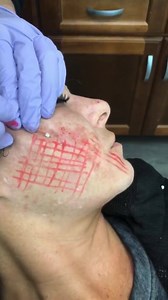 Amazing AAFE solid filler twist PDO Threadlift to build collagen, tighten and smooth the cheeks and smooth acne scars. Solid Filler Smooth PDO Threadlifts is a very precision technique and knowing the anatomy is the most important aspect to get the best esthetic results!! You can get AAFE certification trained and do this too, what are you waiting for? Do this for your patients! Invest in yourself and invest in your practice! Get AAFE Certification Training Today! ⠀⠀ We have our National Novembe