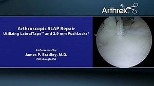 Arthroscopic SLAP Repair Utilizing LabralTape™ and 2.9 mm PushLock® Suture Anchors