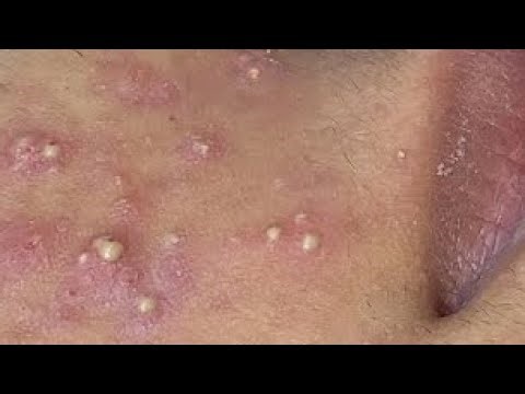 Massive Pimple Explosion 😱 | Oddly Satisfying