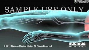 深静脉血栓和肺栓塞-3D医学动画