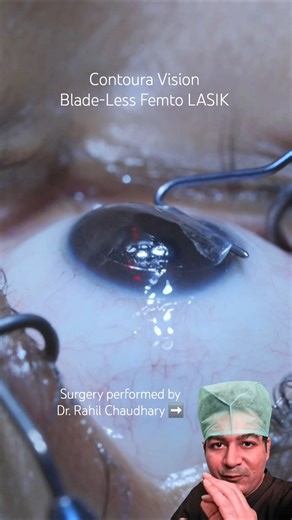 Contoura Vision Blade-Less Femto LASIK procedure #lasik #contouralasik #lasiksurgery