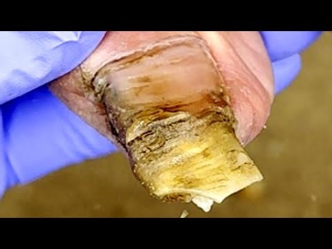 Long Gray Nails Curled Up! Professional Pedicure