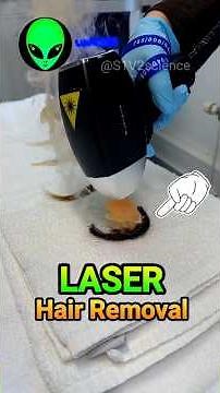 laser hair removal process by S1V2