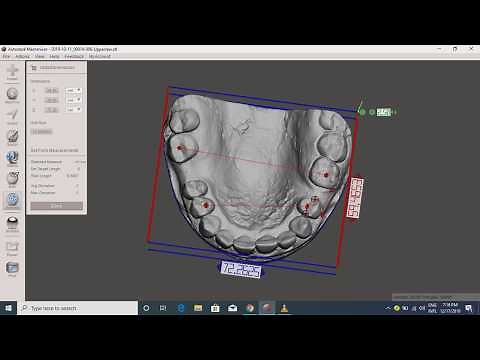 Orthodontic model analysis using Meshmixer