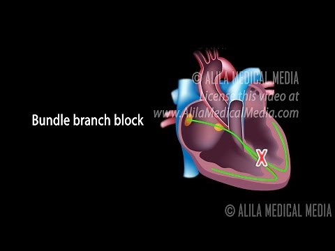 Types of Heart Blocks, Narrated Animation Part 1