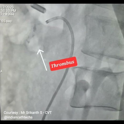 Superior Mesenteric | Thrombectomy | Thrombolysis | Angioplasty