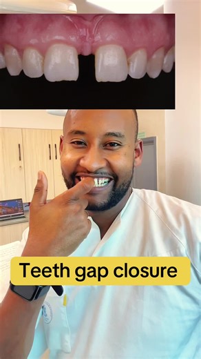 Teeth Gap Closure: Effective Steps to Fix Gap Teeth