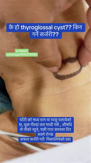 Thyroglossal Cyst Surgery by Dr. Nabin Raj Gautam