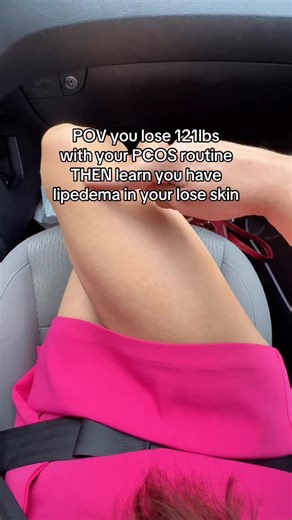 It was always there, I just didn’t realize it. And now in many ways because it causes heaviness, pain, fatigue, and swelling, it still feels like I’m still 250lbs. I manage my lipedema with my essentials like my vibration plate, strength training, massage gun, & anti-inflammatory diet. Thanks to my PCOS routine I was able to get it significantly improved from where it was. But unfortunately because it IS lipedema, it can only be removed permanently with surgery. If you want a list of every tool 
