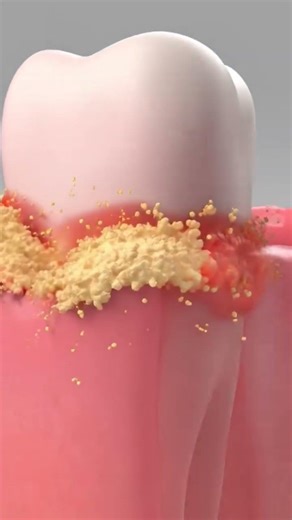 Gingival Recession...Plaque buildup leads to gum inflammation which causes tissue detachment...🦷