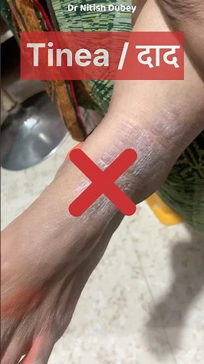 Lichen simplex chronicus #shorts #skincare #skin