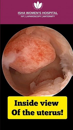 Hysteroscopic polyp removal surgery live! | Dr.Chinmay Pataki | Isha Women’s Hospital