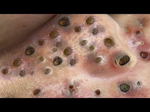 Blackhead Removal With Sac Dep Spa @100074847