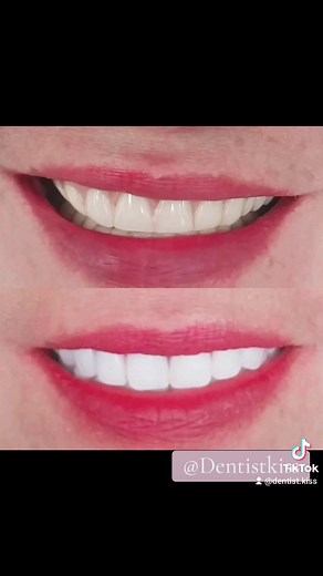 #faceliftdentures #teethwhitening #dentureveneers