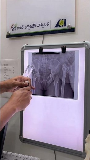 Coxa Vara Treatment Explained with Real Patient Testimonial | Dr Ram Prasad | Hip Deformity Recovery