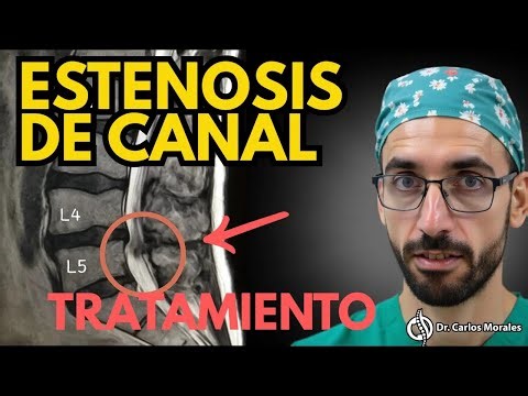 Estenosis de Canal: ¿Necesitas CIRUGÍA? (La verdad que nadie te cuenta) 🤫