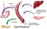 Images of Medical Treatment For Type 1 Diabetes