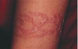 Pictures of Henna Tattoo Allergy Treatment