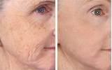 Facial Skin Treatments Wrinkles Photos