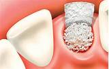 When Can I Chew After Wisdom Teeth E Traction