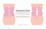 Diastasis Recti Recovery Pictures
