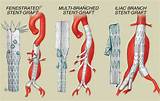 Photos of Stent Medical Definition