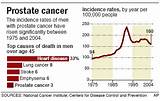 Prostate Cancer Procedures Treatment Pictures