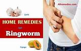 Scalp Ringworm Home Remedies