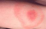 Do I Need To See A Doctor For Shingles Photos