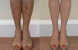 Images of How To Cover Up Scars On Legs With Makeup