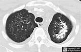 Calcium In Lungs Treatment Images