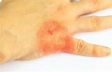 Severe Allergic Skin Reaction Treatment