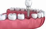 Dental Implants Santa Clara Images