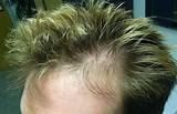 Temple Balding Treatment Photos