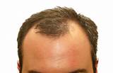 Hair Thinning Treatment Male