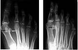 Pictures of Tibial Sesamoid Fracture Treatment