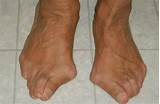 Images of Foot Surgery For Bunions Recovery