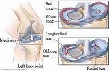 Acl Muscle Strengthening Photos