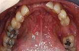 Can Tooth Implant Cause Sinus Problems Photos